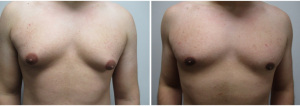 21749-gynecomastia-surgeon-long-island-before-after-1-1