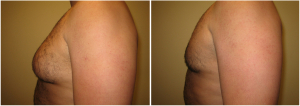 gynecomastia-surgeon-long-island-before-after-1-2