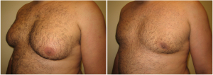 gynecomastia-surgeon-long-island-before-after-1-3