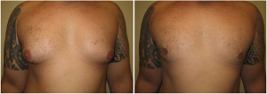 gynecomastia-surgeon-long-island-before-after-10-1