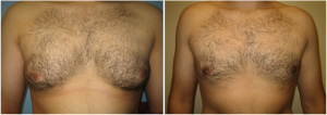 gynecomastia-surgeon-long-island-before-after-11-1