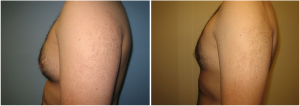 gynecomastia-surgeon-long-island-before-after-11-2