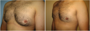 gynecomastia-surgeon-long-island-before-after-11-3