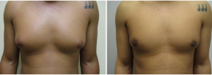 gynecomastia-surgeon-long-island-before-after-12-1