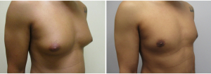 gynecomastia-surgeon-long-island-before-after-12-2