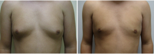 gynecomastia-surgeon-long-island-before-after-13-1