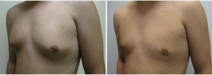 gynecomastia-surgeon-long-island-before-after-13-3