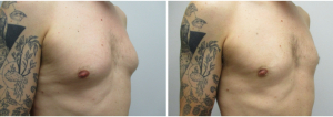 gynecomastia-surgeon-long-island-before-after-14-2