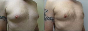 gynecomastia-surgeon-long-island-before-after-15-2