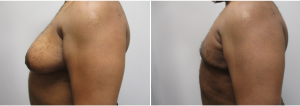 gynecomastia-surgeon-long-island-before-after-16-2