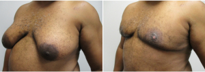 gynecomastia-surgeon-long-island-before-after-16-3