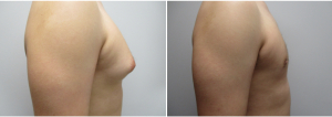 gynecomastia-surgeon-long-island-before-after-17-2