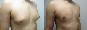 gynecomastia-surgeon-long-island-before-after-17-3