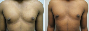 gynecomastia-surgeon-long-island-before-after-18-1