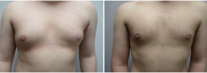 gynecomastia-surgeon-long-island-before-after-19-1