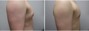 gynecomastia-surgeon-long-island-before-after-19-2