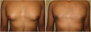 gynecomastia-surgeon-long-island-before-after-2-1