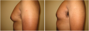 gynecomastia-surgeon-long-island-before-after-2-2