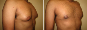 gynecomastia-surgeon-long-island-before-after-2-3