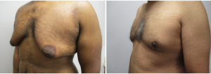 gynecomastia-surgeon-long-island-before-after-21-2