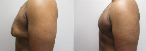 gynecomastia-surgeon-long-island-before-after-21-3