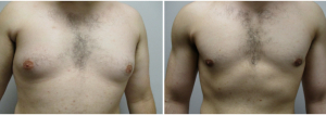 gynecomastia-surgeon-long-island-before-after-22-1