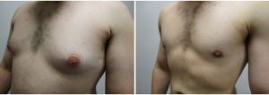 gynecomastia-surgeon-long-island-before-after-22-2