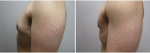 gynecomastia-surgeon-long-island-before-after-22-3