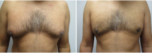 gynecomastia-surgeon-long-island-before-after-23-1