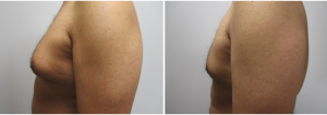 gynecomastia-surgeon-long-island-before-after-23-2