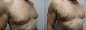 gynecomastia-surgeon-long-island-before-after-24-2