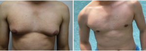 gynecomastia-surgeon-long-island-before-after-25-1