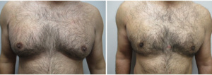 gynecomastia-surgeon-long-island-before-after-27