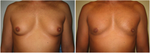 gynecomastia-surgeon-long-island-before-after-3-1