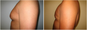 gynecomastia-surgeon-long-island-before-after-3-2