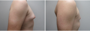 gynecomastia-surgeon-long-island-before-after-30-2