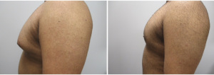 gynecomastia-surgeon-long-island-before-after-34-2