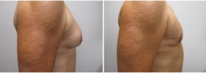 21834-gynecomastia-surgeon-long-island-before-after-1-2