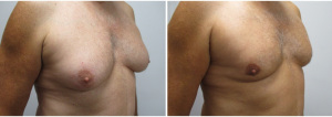 21834-gynecomastia-surgeon-long-island-before-after-1-3