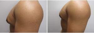 21839-gynecomastia-surgeon-long-island-before-after-1-2