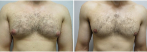 22123-gynecomastia-surgeon-long-island-before-after-1-1