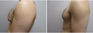 22123-gynecomastia-surgeon-long-island-before-after-1-2
