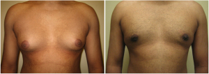 gynecomastia-surgeon-long-island-before-after-4-1