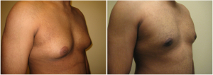 gynecomastia-surgeon-long-island-before-after-4-3