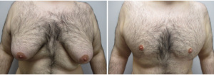gynecomastia-surgeon-long-island-before-after-23-yo-1-5-years-post-op-1