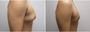 gynecomastia-surgeon-long-island-before-after-28-yo-6-months-post-op-1-2