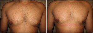 gynecomastia-surgeon-long-island-before-after-5-1