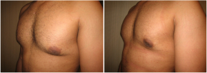 gynecomastia-surgeon-long-island-before-after-5-3