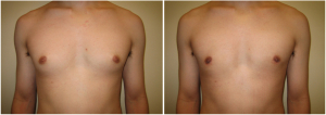 gynecomastia-surgeon-long-island-before-after-6-1