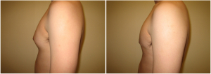 gynecomastia-surgeon-long-island-before-after-6-2